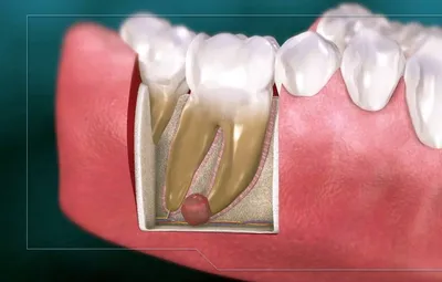 Удаление и лечение кисты зуба в стоматологии LUXAR | Cтоматология Люксар