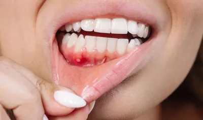 Киста зуба – лечение разными способами
