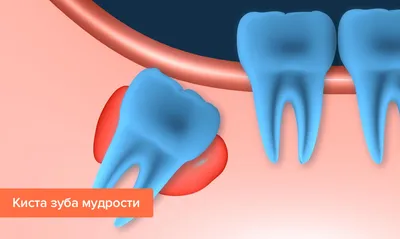 Лечение и удаление кисты зуба в ТОП1 стоматологии Москвы - Немецкий  имплантологический центр