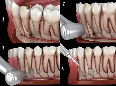 Киста зуба: симптомы и методы лечения | Клиника Меди Лайф