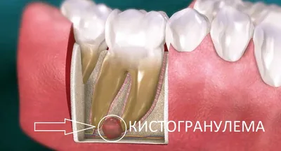 Лечение кисты зуба лазером – отзывы, преимущества, показания