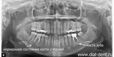 Удаление зуба при кисте и гранулеме в ТОП1 клинике Москвы - Немецкий  имплантологический центр