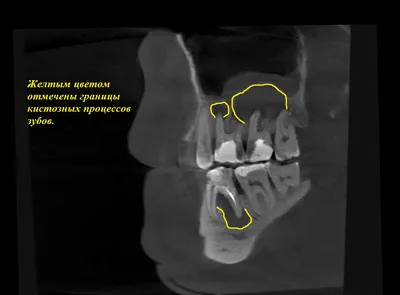 Хирургическое удаление кисты, гранулемы зуба, операция цистэктомия с  резекцией верхушки корня