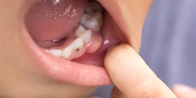 Киста - это всегда удаление зуба?