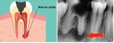 Киста на зубе – лечить или удалить с корнем? | Центр имплантации Доктора  Федорова | Дзен