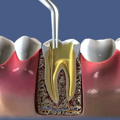 Киста на зубе – лечить или удалить с корнем? | Центр имплантации Доктора  Федорова | Дзен