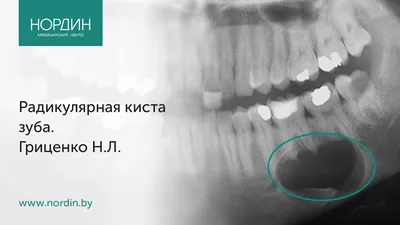 Киста зуба: симптомы, причины появления, чем опасна, методы лечения,  операция по удалению корневой радикулярной кисты в стоматологии