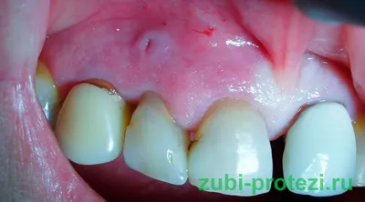 Можно ли ставить имплант при кисте в удаленном зубе