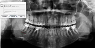 Киста зуба: лечение или удаление