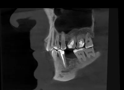 Удаление кисты зуба и одномоментная имплантация зубов в Волжском