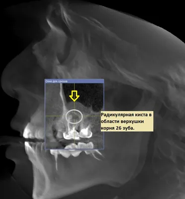 Можно ли спасти зуб с кистой от удаления? - atlantida74.ru
