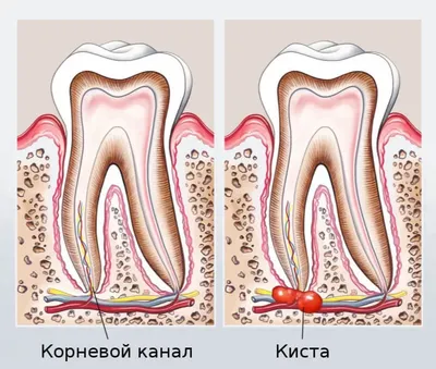 Срочное лечение кисты зуба в Москве