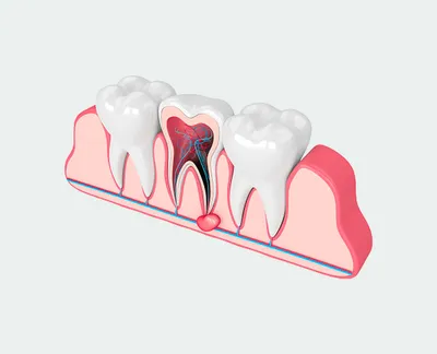Киста зуба ➡️ Причины, последствия и лечение | New Smile