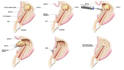 Как Определить Кисту Зуба