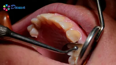 Свищ на десне у ребенка: фото, лечение, что делать | Dental Art