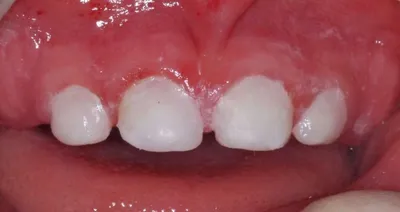 Абсцесс зуба: причины, симптомы, диагностика, лечение