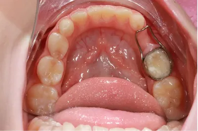 Сукровица после удаления зуба: первая помощь