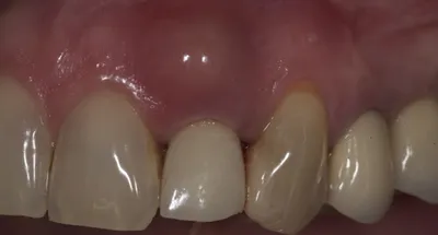 Лечение зуба после давней травмы - детская стомалогия Nikadent Family