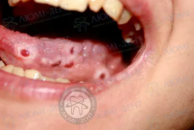 Гранулема зуба: причины и симптомы заболевания, диагностика, лечение  воспаления верхушки корня, удаление в клинике