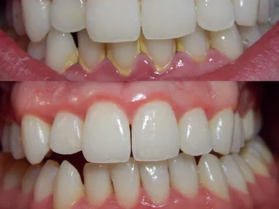 Удаление кисты зуба – показания, методы операции, можно ли вылечить без  удаления