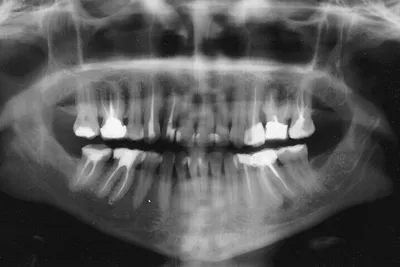 dental_studio_56 - Откуда берется киста прорезывания❓ Киста или гематома  прорезывания - это вид доброкачественных опухолей мягких тканей. Появляется  она, когда зубик уже начал прорезываться через десну. Иногда можно увидеть  синевато-багровое пятно над