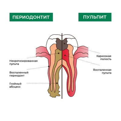 Дермоидная киста корня языка - DENTALMAGAZINE.RU