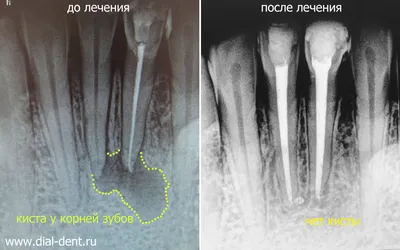 Нехирургическое лечение кисты зуба