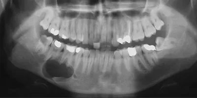 Чем опасна киста корня зуба? | TopDent | Дзен