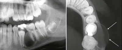 Ортопантомограмма – панорамный снимок зубов в Калининграде