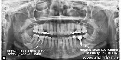 Киста зуба – лечение разными способами