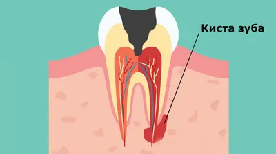 Киста зуба [симптомы, методы лечение, как выглядит, причины]