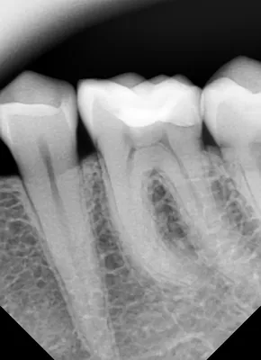 Клинический случай 1 зубной канал | Стоматологическая клиника Оланко каналы  1 Оланко™