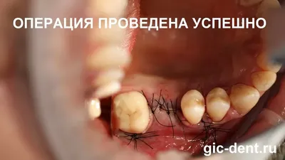 Периостотомия - удаление кисты зубы - «Большая киста между корней зуба под  коронкой. Периодонтит. Удаление в бесплатной клинике. Подробный отзыв с  фотографиями снимка, удаленной кисты и зуба. Полезные советы.» | отзывы