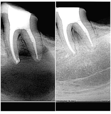 Киста зуба: лечение и причины возникновения. — Стоматология МедМар