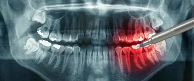 КТ (компьютерная томография) зубов в Москве – цены в стоматологических  клиниках Зуб.ру