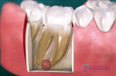 Лечение кисты зуба и гранулем без удаления в Ростове на Дону | Сохраняем  зубы с большими воспалениями\"