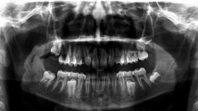 Киста зуба? - Стоматология - Форум стоматологов (стомотологический форум) -  Профессиональный стоматологический портал (сайт) «Клуб стоматологов»