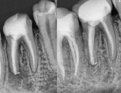 Алгоритм внутриротового лучевого исследования и описания снимков зубов -  DENTALMAGAZINE.RU