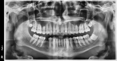 Киста зуба | Стоматология \"Ультра-Дент\" | Дзен