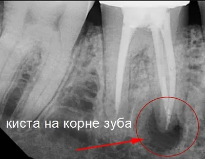 темное пятно на рентгене зуба - Хирургическая стоматология - Стоматология  для всех