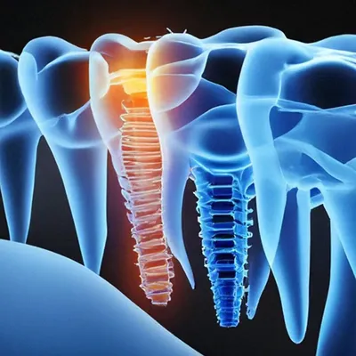 Киста зуба на 3Д снимке: раскрытие тайн с помощью рентгеновского снимка