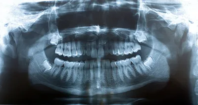 Затемнения на панорамном снимке - Стоматология - Форум стоматологов  (стомотологический форум) - Профессиональный стоматологический портал  (сайт) «Клуб стоматологов»