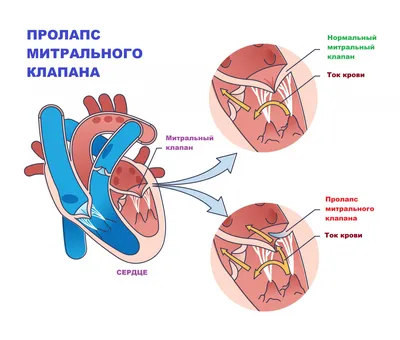 Пороки клапанов сердца