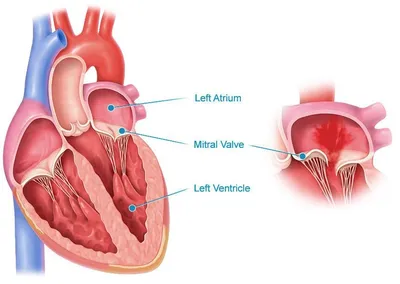 Болезни сердечного клапана | Первый клинический медицинский центр
