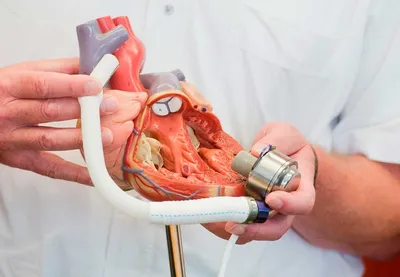 Минимально-инвазивная замена клапана TAVI (транскатетерная имплантация  аортального клапана) или открытая операция по замене аортального клапана? |  Patient-mt.ru - организация лечения за рубежом без посредников