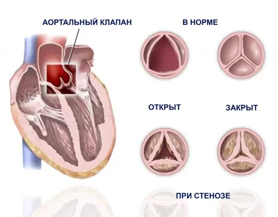 Замена аортального клапана ▷ операция по замене сердечного клапана ⚕️  MedTour