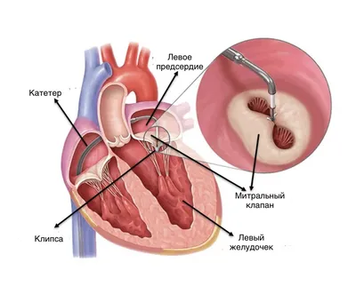 Болезни клапанов сердца-почему и как возникают и что с этим делать? |  Доктор Жизнь | Дзен
