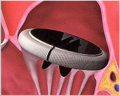 В ФЦССХ им. С.Г. Суханова впервые имплантировали аортальный клапан сердца  по технологии «клапан-в-