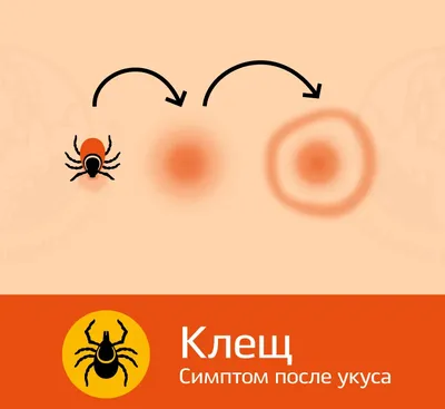 Как защититься от клещей на природе: что делать, если укусил клещ - 28 мая  2023 - 45.ru