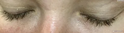 Демодекоз глаз у человека - лечение
